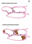Comparaison alvéole pulmonaire saine et fumeur