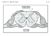 Tle Moelle epiniere Coupe Relief 10098.pdf - URL